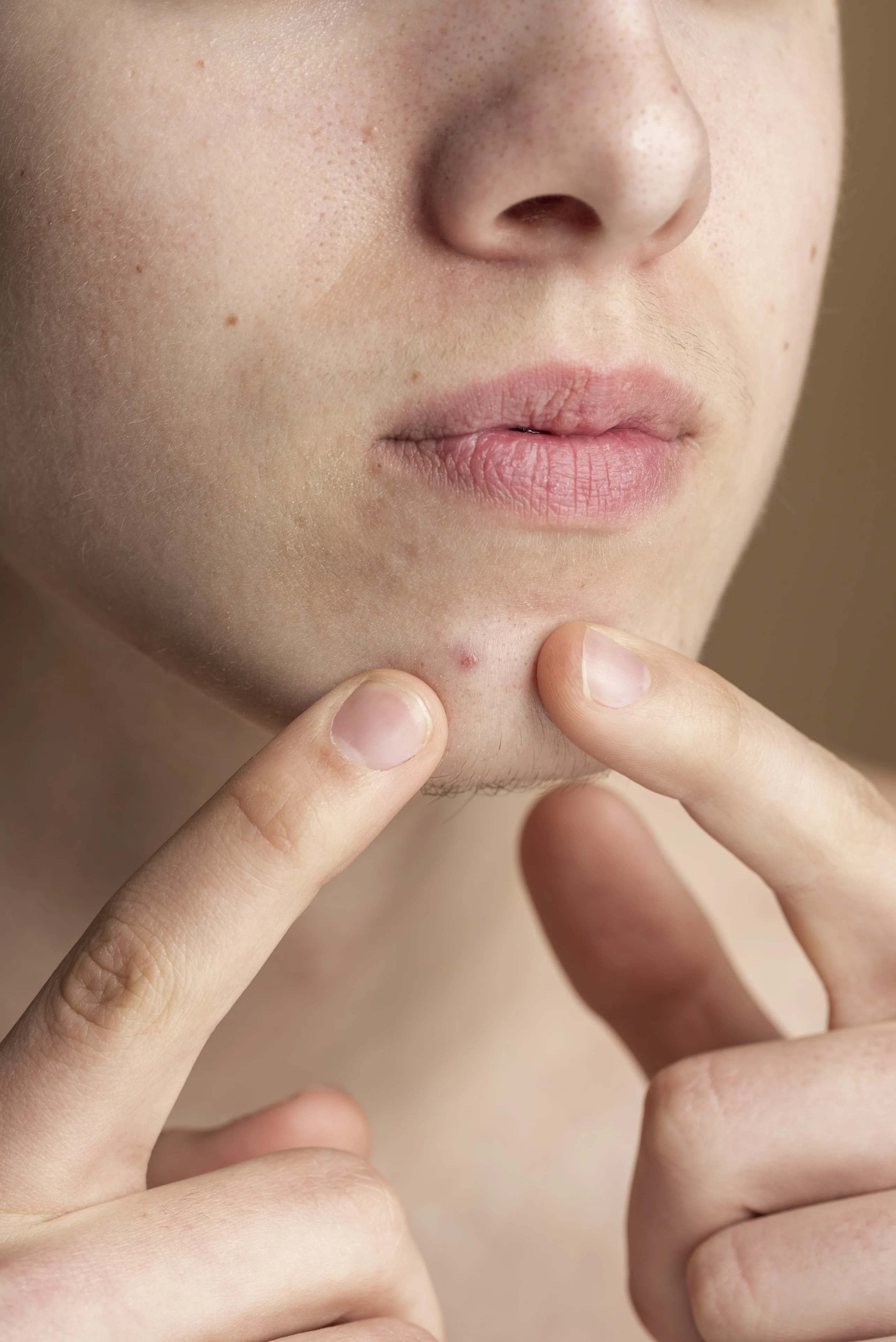 Squeezing a pimple can lead to acne scars